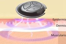 Pomladite i zategnite svoje lice djelovanjem mikro struje