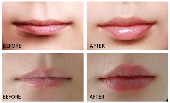 POVEĆAJTE USNE Jednostavnom metodom do super rezultata