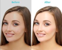 Laserska plazma olovka 6