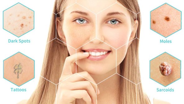 Laserska plazma olovka 2