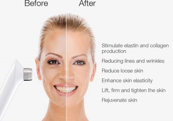 Uređaj za podizanje lica 2.jpg