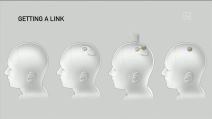Neuralink ugradnja čipa u mozak (3).jpg