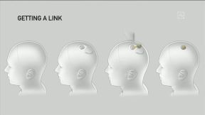 Neuralink ugradnja čipa u mozak (3).jpg
