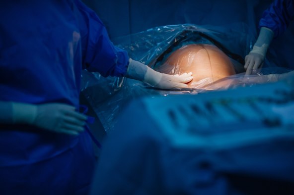 Porod s epiduralnom