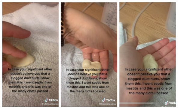 mlijeko kada imate mastitis