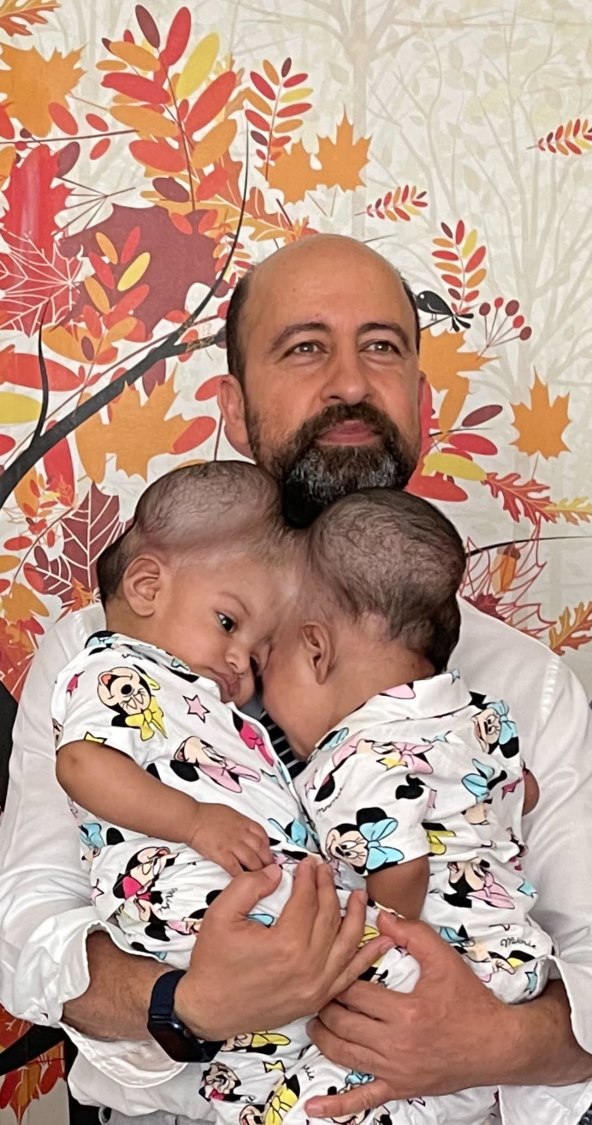 Kako izgledaju sijamske blizanke Minal i Mirha nakon razdvajanja?