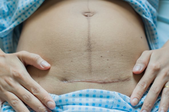 8 stvari koje nisam znala prije carskog reza