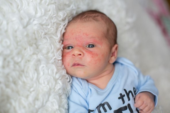 atopijski dermatitis - simptomi i kako ga lijeciti