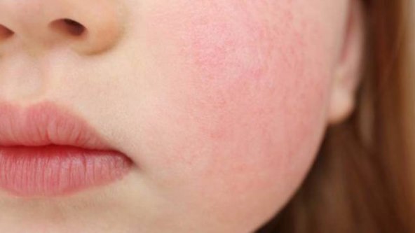 Koje su najcešca kožna stanja i bolesti kod djece?