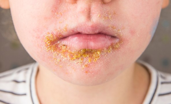 Slatke kraste ili impetigo je cesta ljetna infekcija kod beba i djece