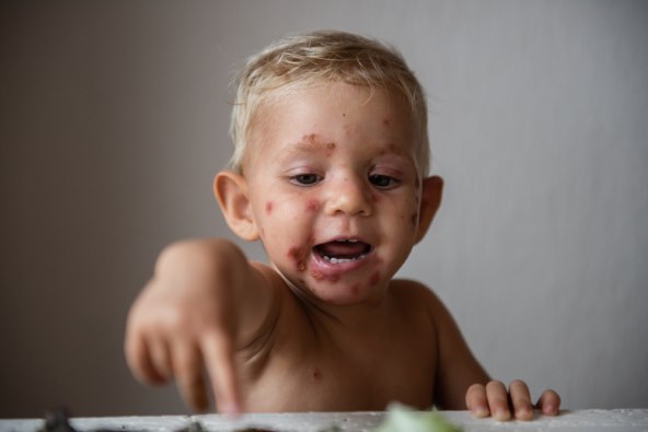 impetigo je visokozarazan