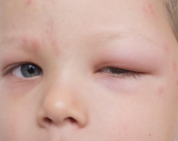 koji su simptomi anafilaktickog šoka nakon uboda ose, pcele, stršljena