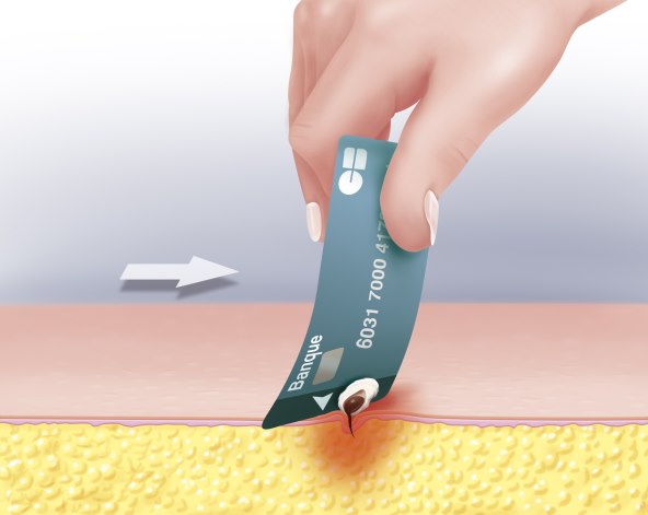 koji su simptomi anafilaktickog šoka nakon uboda ose, pcele, stršljena