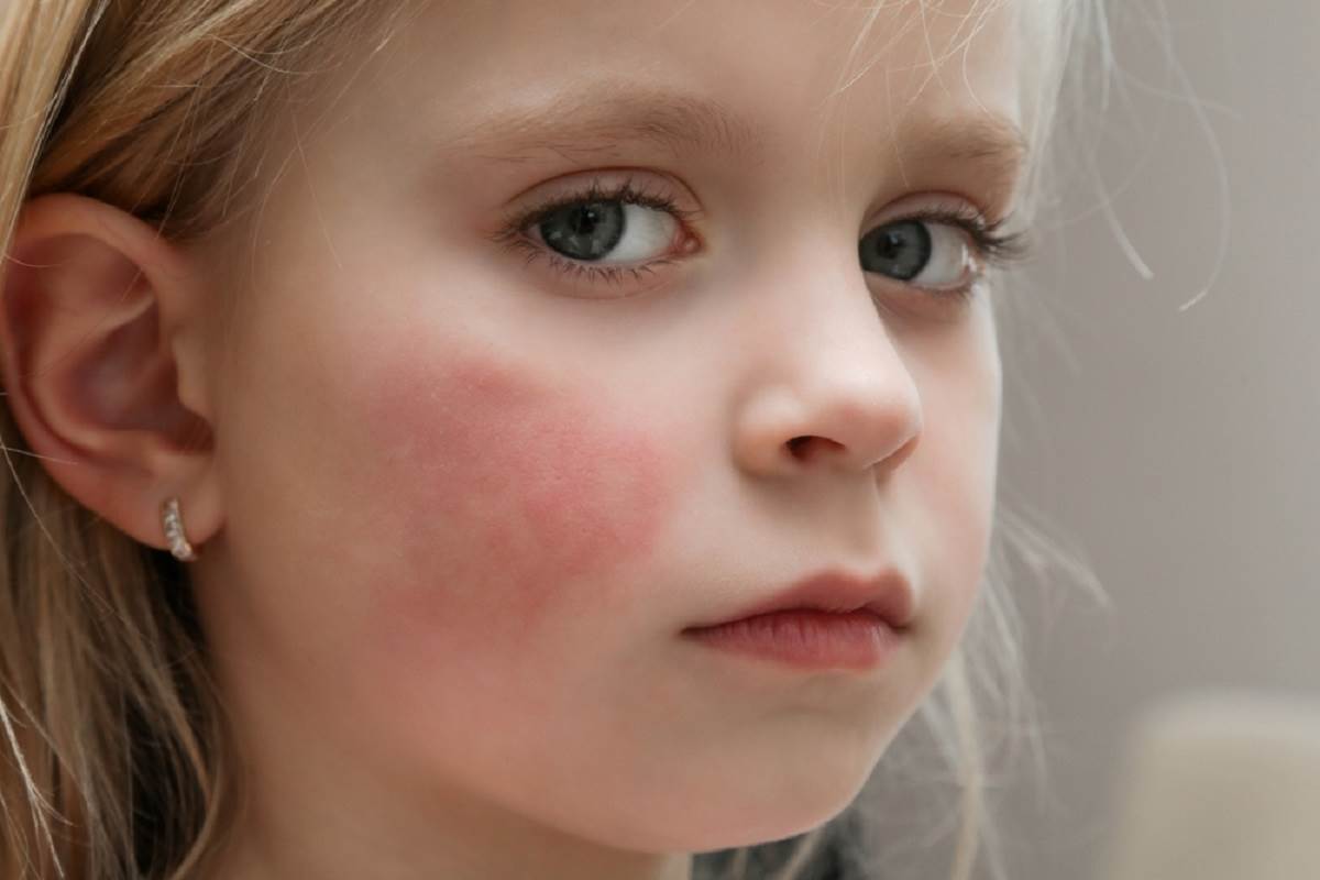 Peta bolest kod djece - simptomi i lijecenje osipa i crvenila | Story