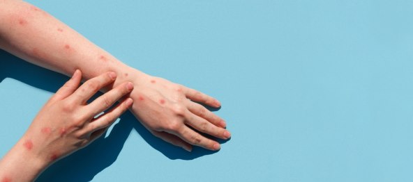 Trudnice u Hrvatskoj u opasnosti od denge virusa koji prenose komarci
