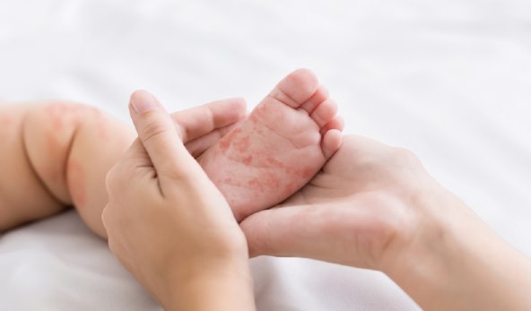 Dvoje djece umrlo od ospica u SAD-u, djecja infektologinja o simptomima i cjepivu