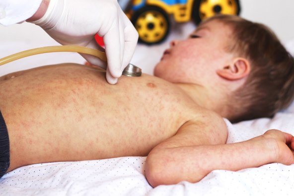 Ospice – WHO upozorava da je cijepljenje ključno za sprječavanje epidemija
