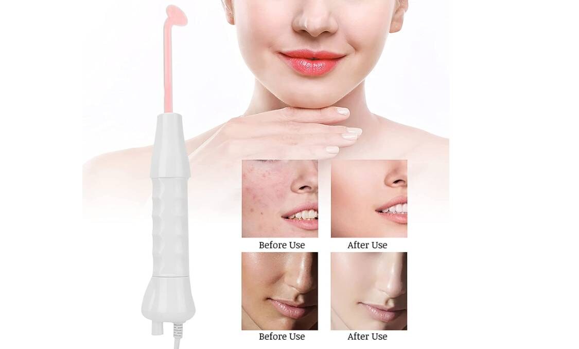 Visokofrekventni uređaj za ljepšu kožu 3