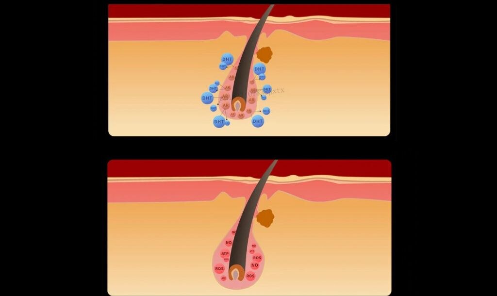 KACIGA S LASERSKOM TERAPIJOM Kosa će vam biti kvalitetnija i brže rasti