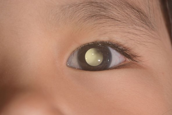 Retinoblastom kod bebe - bijeli sjaj u oku otkriven fotografijom