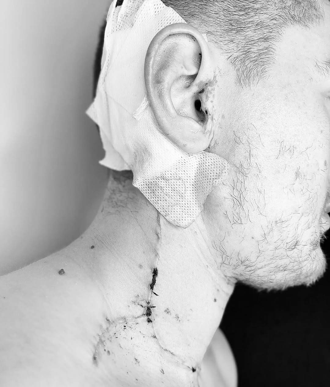 War wounds #3weeksout #melanomaawareness #melanomaisSHITE #surviving (2).jpg