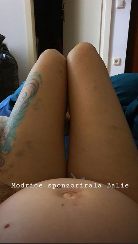 Ella Dvornik puna modrica