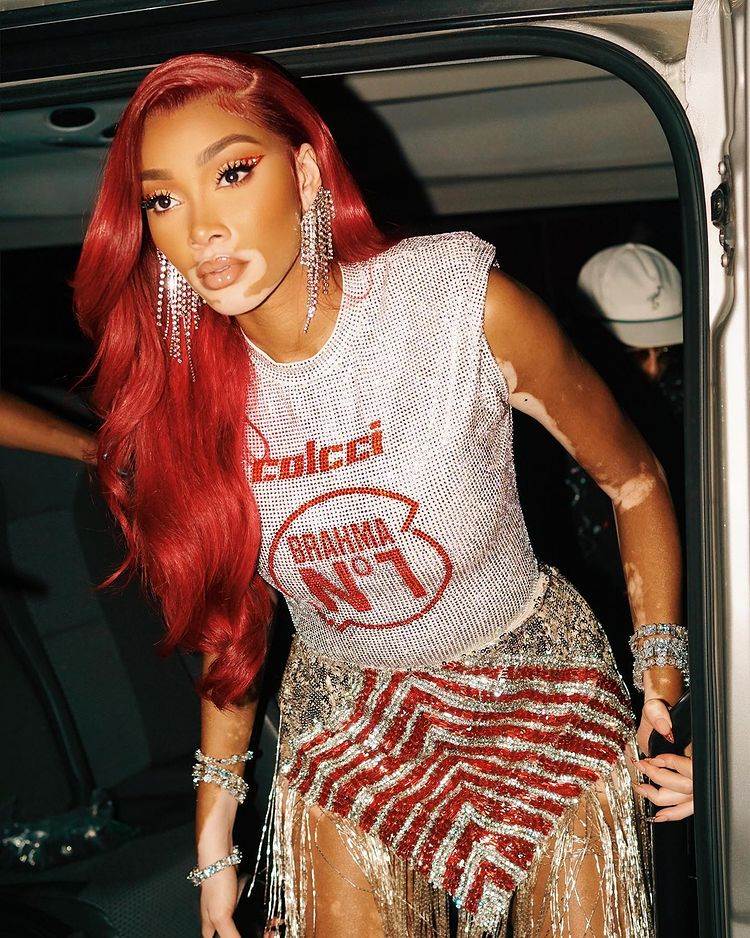 Manekenka Winnie Harlow boluje od vitiliga