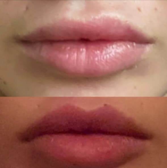 Povećanje usana Elle Dvornik