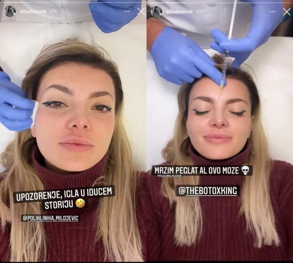 Ella Dvornik na tretmanu botoksom