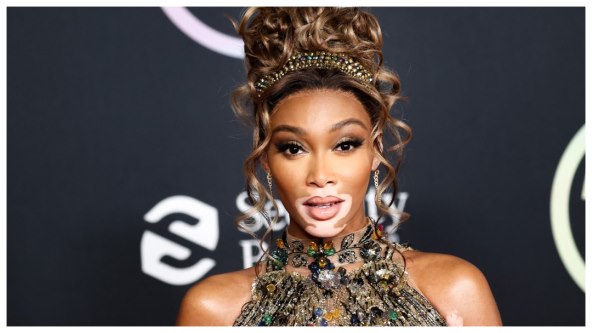 Winnie Harlow vitiligo
