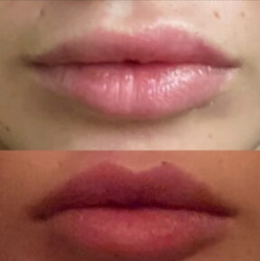 Povećanje usana Elle Dvornik