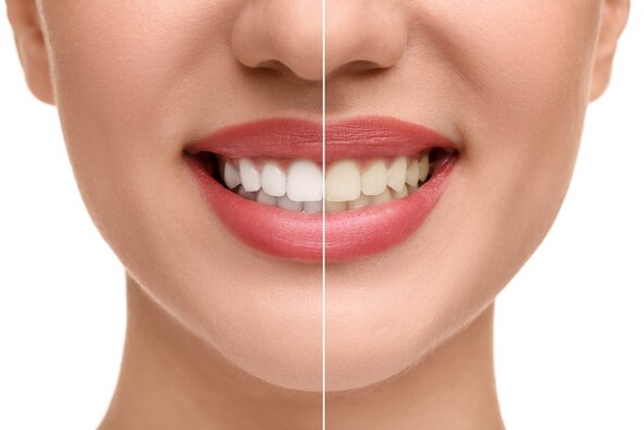 zubi, osmijeh