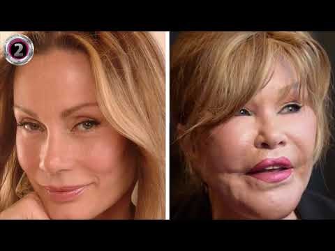 Jocelyn Wildenstein prije operacija