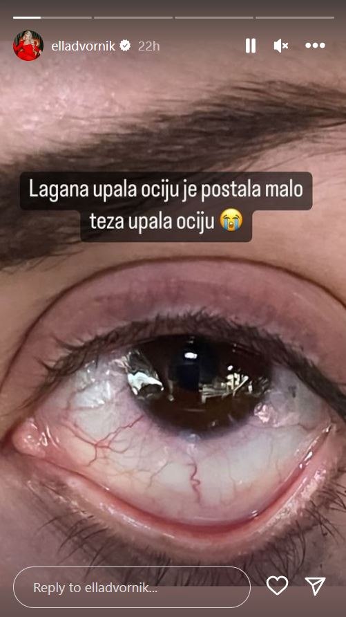 Ella Dvornik otkrila kako ima upalu očiju