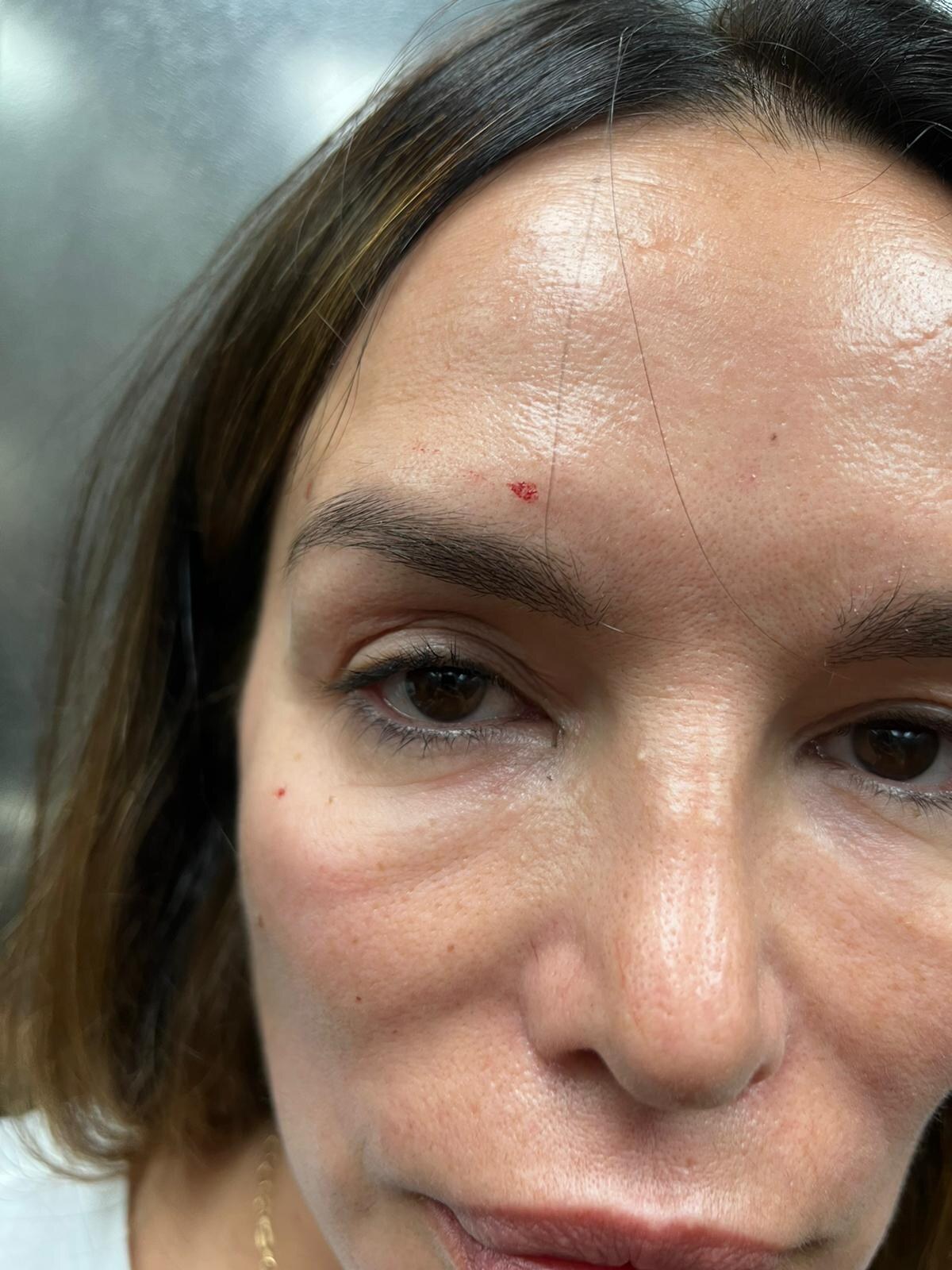 Severinine ozljede nakon sukoba sa sestrom