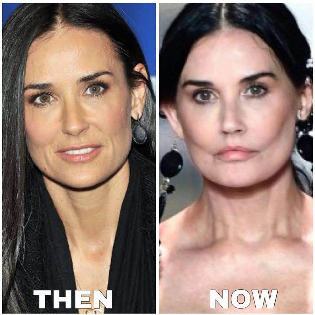 demi moore plastična operacija