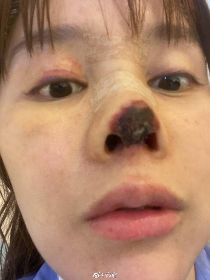POTRESNE FOTOGRAFIJE Glumica zbog estetske operacije ostala bez dijela nosa