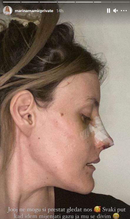 Marina Mamić nakon operacije nosa: 'Sada mi je samo nebo granica' 