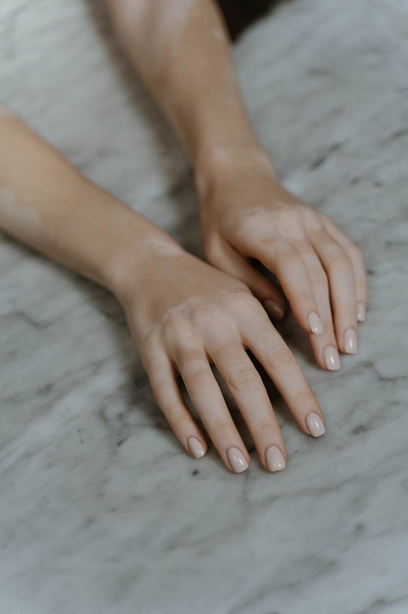 Vitiligo na rukama-FOTO-RonLach-