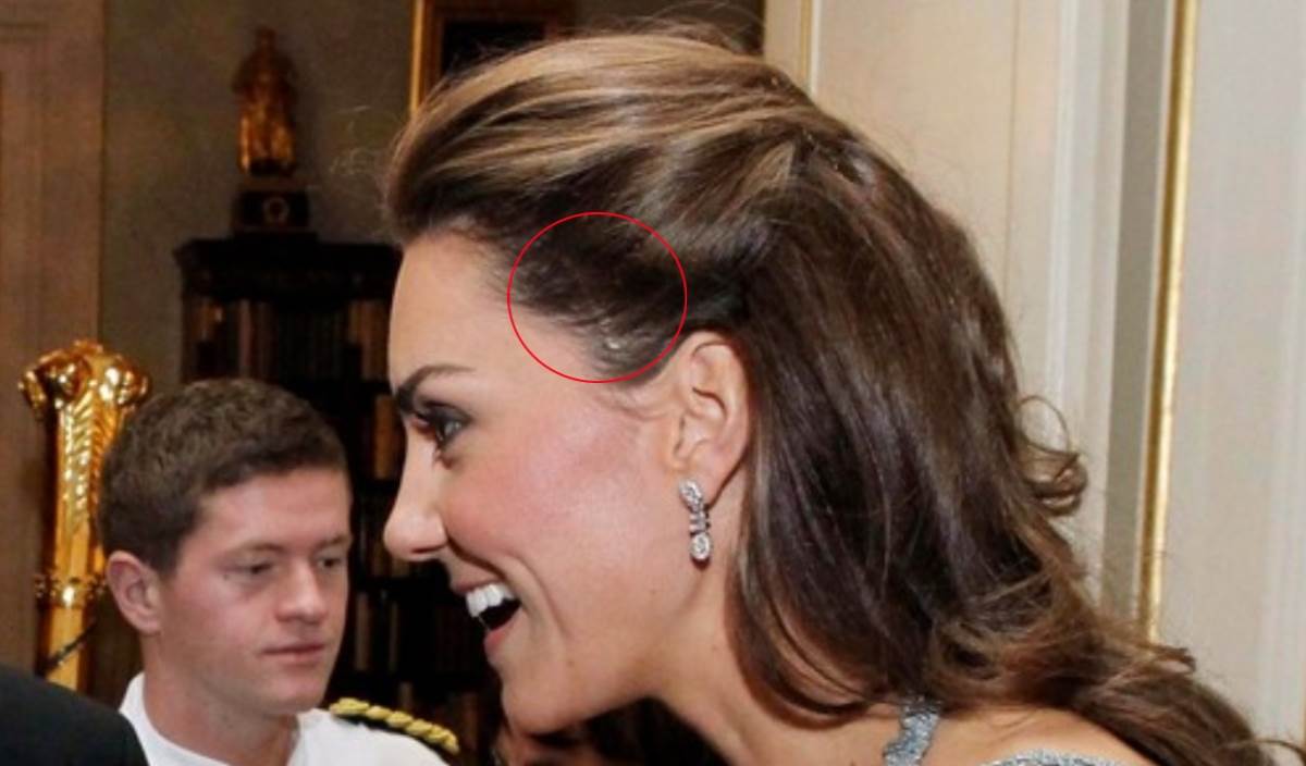 Kate Middleton ima ožiljak od uklanjanja urođenog madeža