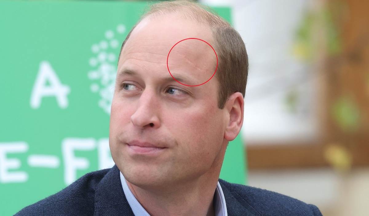 Princ William ima ožiljak na sličnom mjestu kao i Kate Middleton