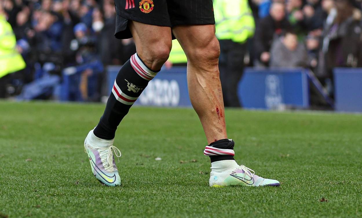 Cristiano Ronaldo se ozlijedio na utakmici Manchestera Uniteda protiv Evertona