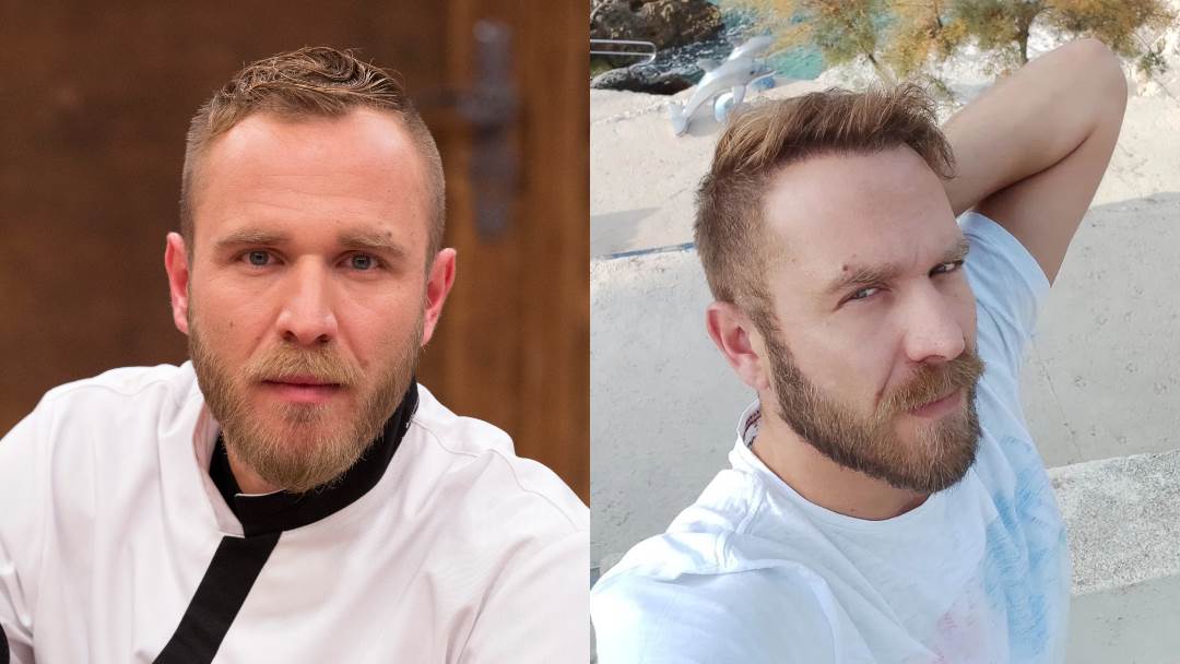 Ivan Pažanin prije i poslije transplantacije kose