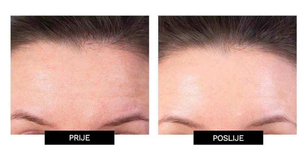 Tripolar stop X 5.jpg