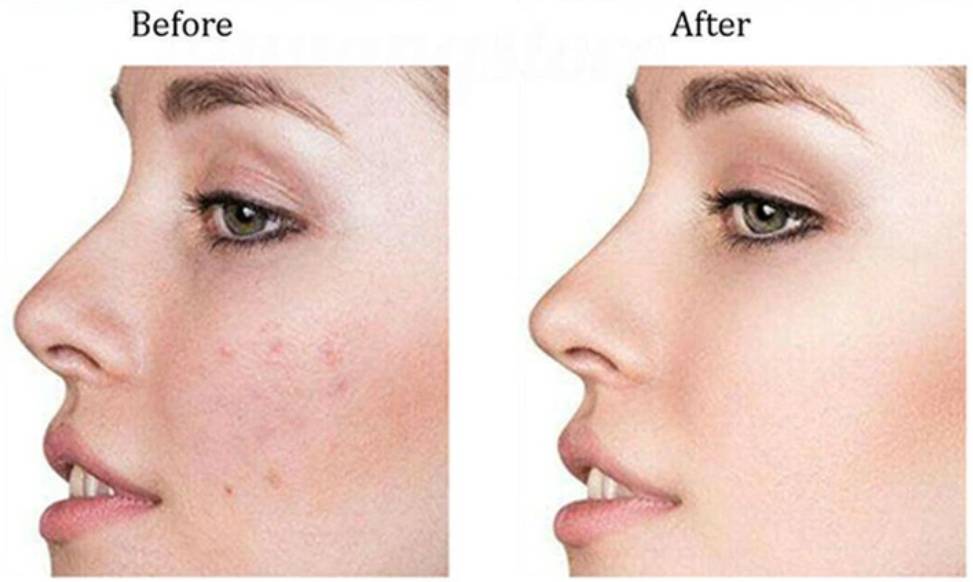 Uređaj za podizanje lica 4.jpg