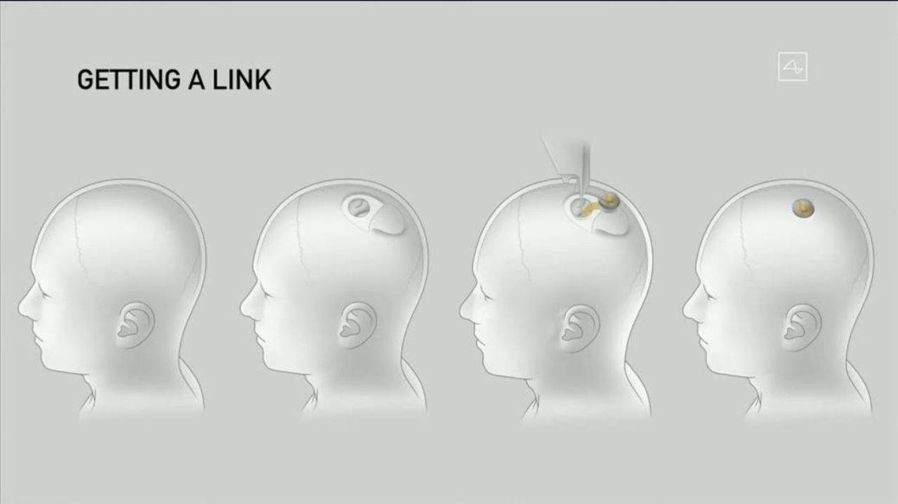 Neuralink ugradnja čipa u mozak (3).jpg