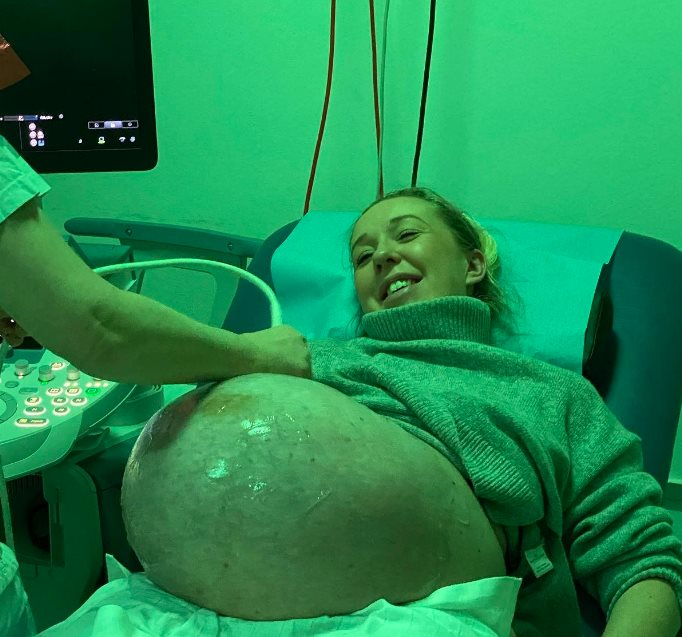 Kako izgleda trbuh trudnice koja nosi trojke