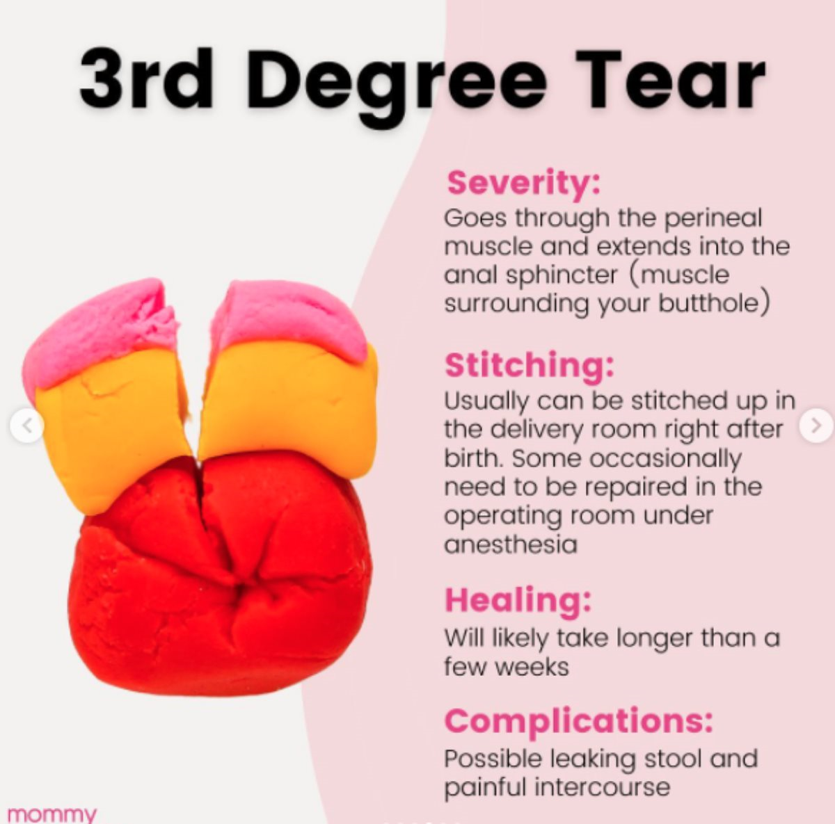 Kako izgleda rezanje pri porodu