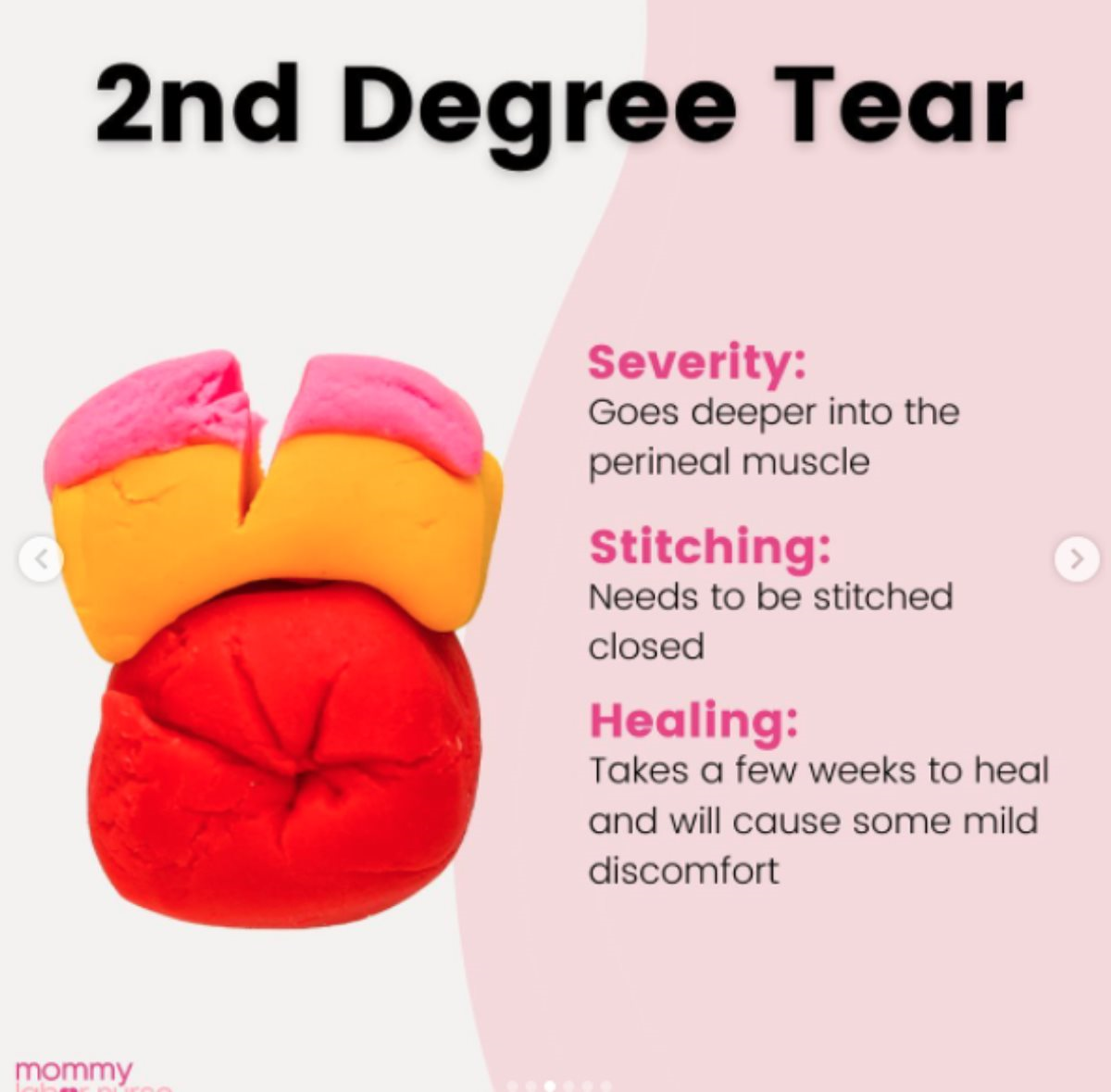 Kako izgleda rezanje pri porodu