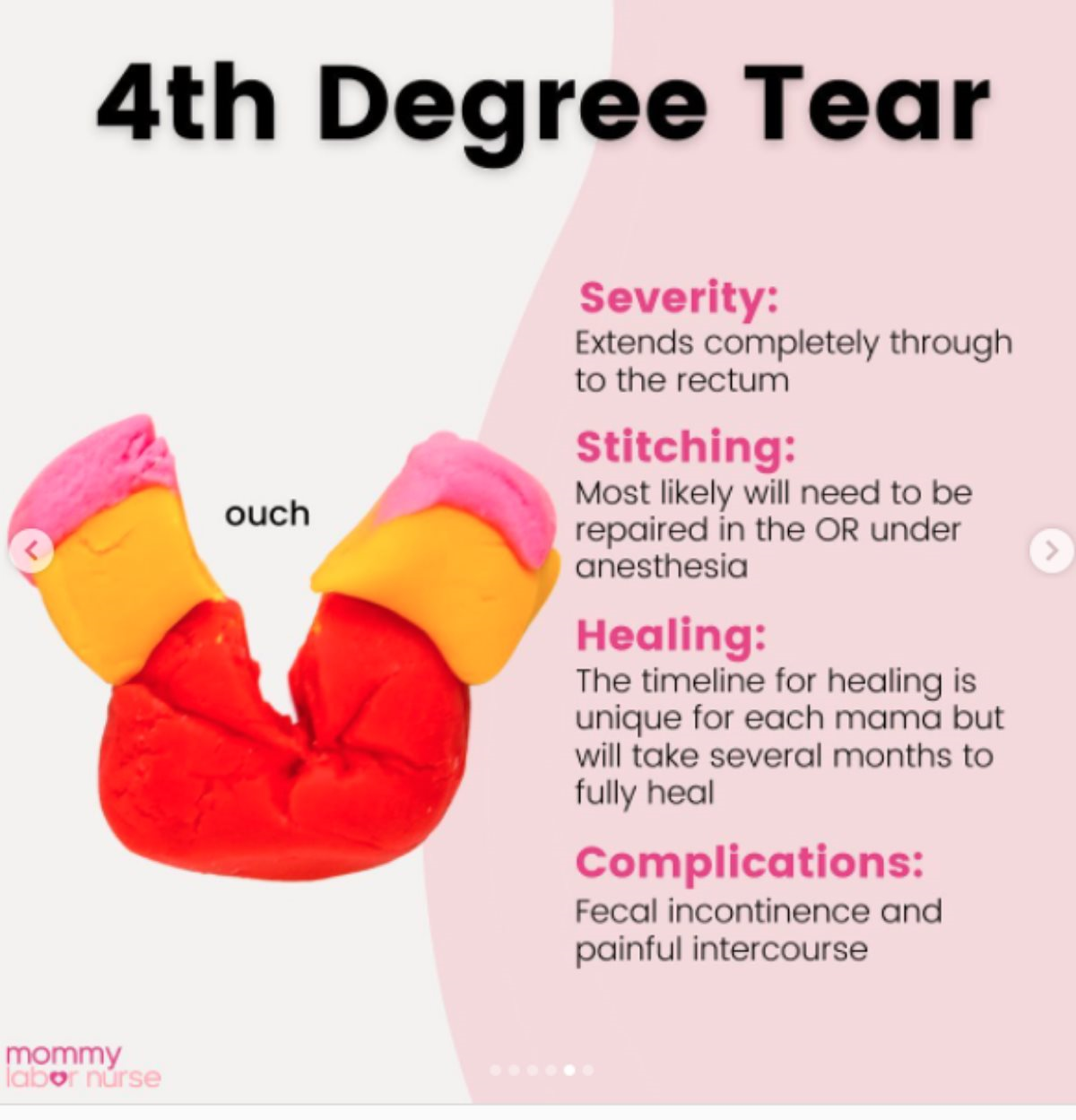 Kako izgleda rezanje pri porodu